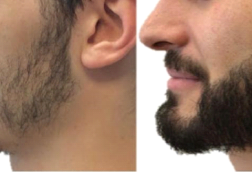 Before Hair Transplantation