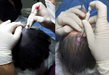 Hair Transplantation For Women in Istanbul