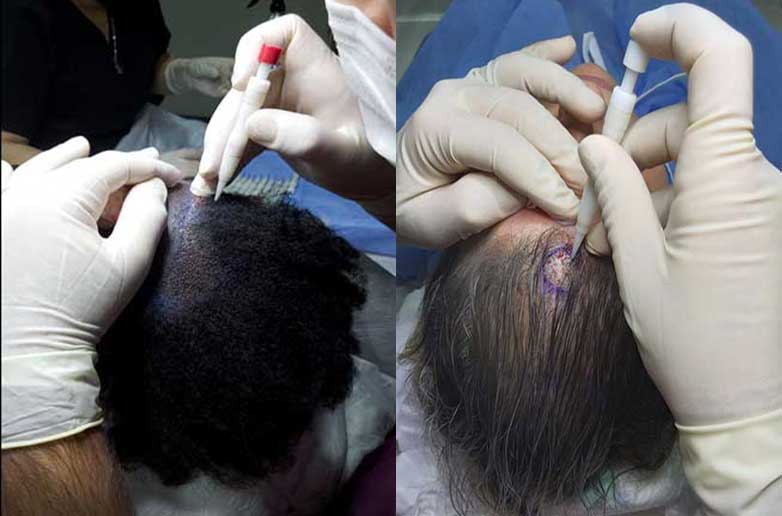 Hair Transplantation DHI technique without shaving انواع مختلفة لزراعة الشعر
