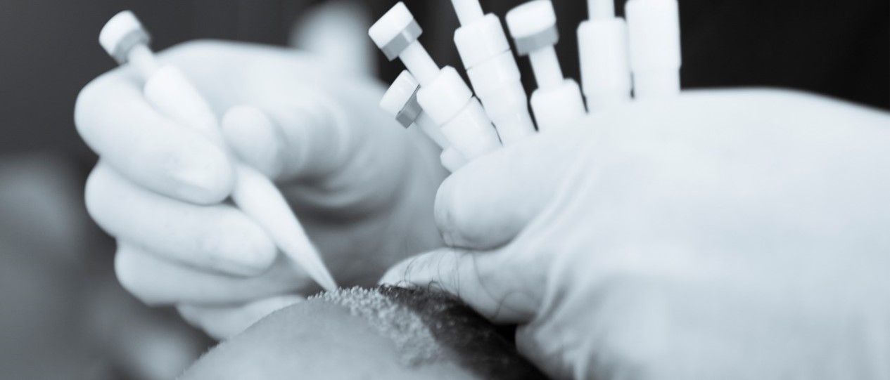 Hair-transplantation-DHI-technique