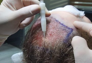 DHI Hair Transplant in Istanbul Turkey
