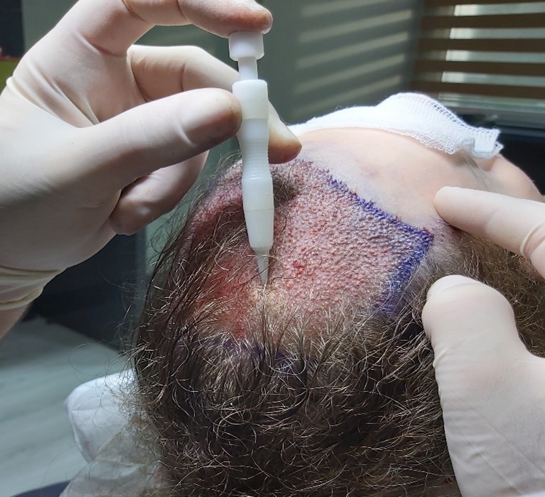 DHI Hair Transplant in Istanbul Turkey - Best Line Clinic