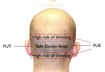 Grafts Calculation/How Many Grafts Do I Need?