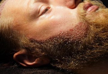 Beard and Moustache Transplantation in Turkey