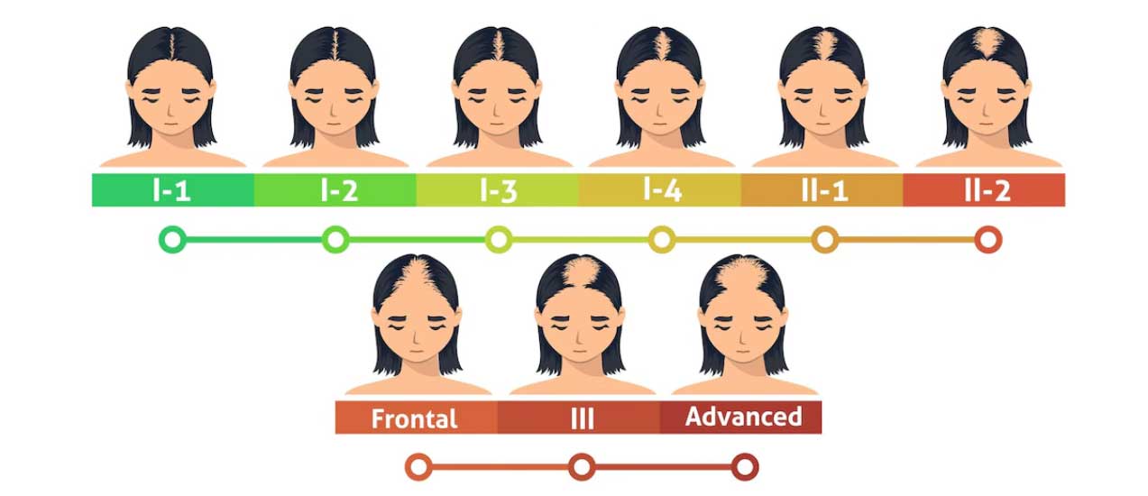 Picture 2: Ludwig Scale of Hair Loss in Women