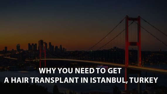 Why You Need to Get a Hair Transplant in Istanbul, Turkey